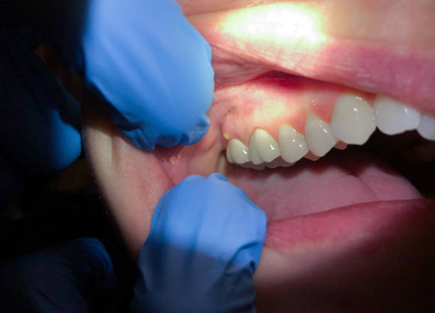 Best Emergency Care for Gum Disease in West Fargo, ND