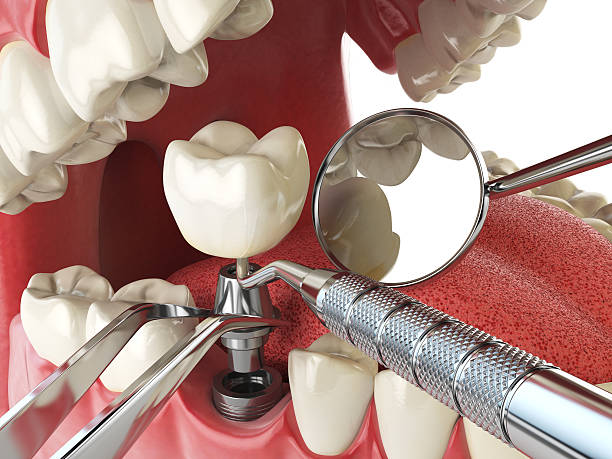 Best Broken or Chipped Tooth Repair in West Fargo, ND